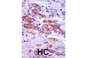 Formalin-fixed and paraffin-embedded human cancer tissue reacted with the primary antibody, which was peroxidase-conjugated to the secondary antibody, followed by DAB staining. (Casein Kinase 1 delta antibody  (C-Term))