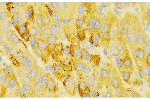 Immunohistochemistry of paraffin-embedded Human liver cancer using LAMP3 Polyclonal Antibody at dilution of 1:100 (40x lens). (LAMP3 antibody)