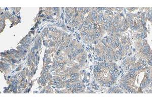 ABIN6277142 at 1/100 staining Human cervical cancer tissue by IHC-P. (CYP2E1 antibody  (Internal Region))