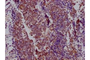 IHC image of ABIN7127859 diluted at 1:100 and staining in paraffin-embedded human lung cancer performed on a Leica BondTM system. (Recombinant NKX2-1 antibody)