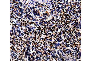 Immunohistochemistry of Human stomach cancer  using S100A4 Polyclonal Antibody at dilution of 1:100 (s100a4 antibody)