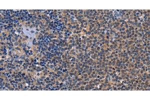 Immunohistochemistry of paraffin-embedded Human Lymphoma tissue using GDF11 Polyclonal Antibody at dilution 1:30 (GDF11 antibody)