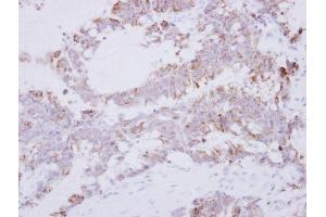 IHC-P Image Immunohistochemical analysis of paraffin-embedded human colon carcinoma, using GRAP2, antibody at 1:500 dilution. (GRAP2 antibody)