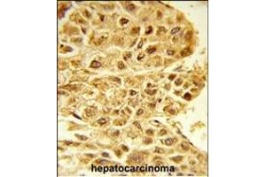 Formalin-fixed and paraffin-embedded human hepatocarcinoma reacted with E2F5 Antibody (N-term), which was peroxidase-conjugated to the secondary antibody, followed by DAB staining. (E2F5 antibody  (N-Term))