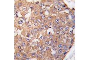 Formalin-fixed and paraffin-embedded human breast carcinoma tissue reacted with SNK Antibody (C-term ) , which was peroxidase-conjugated to the secondary antibody, followed by DAB staining. (PLK2 antibody  (C-Term))