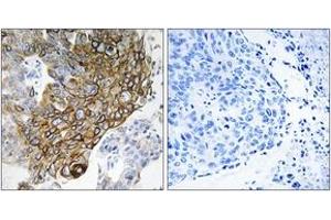 Immunohistochemistry analysis of paraffin-embedded human lung carcinoma tissue, using GJA3 Antibody. (GJA3 antibody  (AA 151-200))