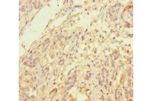 Immunohistochemistry of paraffin-embedded human pancreatic cancer using ABIN7173968 at dilution of 1:100 (INPP4B antibody  (AA 1-53))