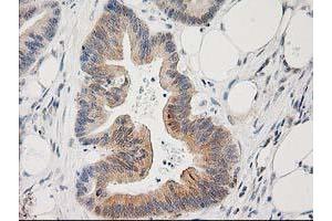 Immunohistochemical staining of paraffin-embedded Adenocarcinoma of Human colon tissue using anti-PLEKHA3 mouse monoclonal antibody. (PLEKHA3 antibody)
