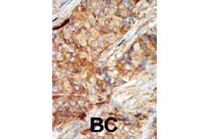 Formalin-fixed and paraffin-embedded human cancer tissue reacted with GCK polyclonal antibody  , which was peroxidase-conjugated to the secondary antibody, followed by AEC staining. (GCK antibody  (N-Term))