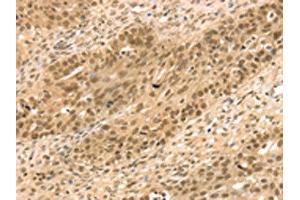 The image on the left is immunohistochemistry of paraffin-embedded Human breast cancer tissue using ABIN7131203(STAG2 Antibody) at dilution 1/35, on the right is treated with fusion protein. (STAG2 antibody)