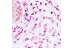 Immunohistochemical analysis of BARD1 staining in human lung cancer formalin fixed paraffin embedded tissue section.