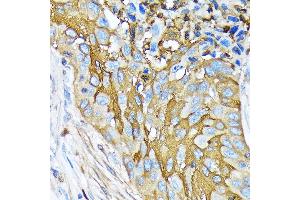 Immunohistochemistry of paraffin-embedded human lung squamous carcinoma tissue using Involucrin Rabbit mAb (ABIN6128025, ABIN6141815, ABIN6141818 and ABIN7101419) at dilution of 1:100 (40x lens). (Involucrin antibody)