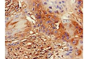 Immunohistochemistry of paraffin-embedded human cervical cancer using ABIN7164355 at dilution of 1:100