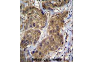 RNF11 Antibody immunohistochemistry analysis in formalin fixed and paraffin embedded human breast carcinoma followed by peroxidase conjugation of the secondary antibody and DAB staining. (RNF11 antibody  (AA 64-90))