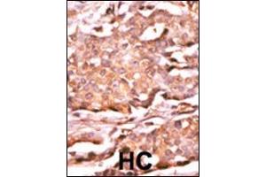Formalin-fixed and paraffin-embedded human cancer tissue reacted with the primary antibody, which was peroxidase-conjugated to the secondary antibody, followed by AEC staining. (RAD9A antibody  (pSer272))