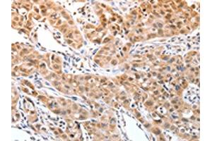 The image on the left is immunohistochemistry of paraffin-embedded Human lung cancer tissue using ABIN7129251(DPPA2 Antibody) at dilution 1/30, on the right is treated with fusion protein. (DPPA2 antibody)