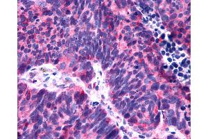 Anti-P2RY6 / P2Y6 antibody IHC of human Lung, Small Cell Carcinoma.