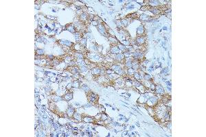 Immunohistochemistry of paraffin-embedded human lung cancer using FGD1 antibody (ABIN7267284) at dilution of 1:100 (40x lens).