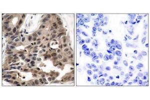 Immunohistochemical analysis of paraffin-embedded human breast carcinoma tissue using 4E-BP1 (Ab-36) antibody (E021215). (eIF4EBP1 antibody)