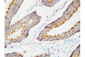 Anti-BCAT2 antibody, IHC(P) IHC(P): Human Colon Cancer Tissue (BCAT2 antibody  (C-Term))