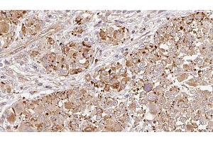 ABIN6269006 at 1/100 staining Human melanoma tissue by IHC-P. (Metabotropic Glutamate Receptor 6 antibody  (C-Term))