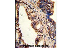 Formalin-fixed and paraffin-embedded human prostate carcinoma with TGM4 Antibody , which was peroxidase-conjugated to the secondary antibody, followed by DAB staining. (TGM4 antibody  (AA 135-164))