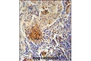 TYROBP Antibody (C-term) (ABIN653819 and ABIN2843091) immunohistochemistry analysis in formalin fixed and paraffin embedded human lung carcinoma followed by peroxidase conjugation of the secondary antibody and DAB staining.