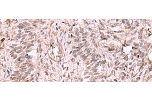 Immunohistochemistry of paraffin-embedded Human ovarian cancer tissue using KDM7A Polyclonal Antibody at dilution of 1:35(x200) (JHDM1D antibody)