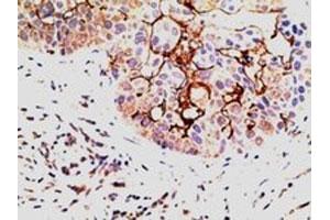 EPS8 polyclonal antibody (Cat # PAB6473, 5 ug/mL) staining of paraffin embedded human breast Carcinoma.