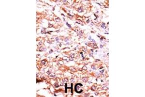 Formalin-fixed and paraffin-embedded human cancer tissue reacted with the primary antibody, which was peroxidase-conjugated to the secondary antibody, followed by AEC staining. (GUCY1A2 antibody  (N-Term))