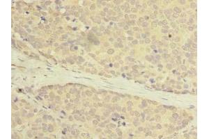 Immunohistochemistry of paraffin-embedded human gastric cancer using ABIN7175069 at dilution of 1: 100