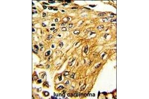 Formalin-fixed and paraffin-embedded human lung carcinoma reacted with IFNGR2 Antibody (C-term), which was peroxidase-conjugated to the secondary antibody, followed by DAB staining. (IFNGR2 antibody  (C-Term))