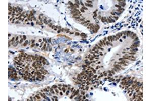 The image on the left is immunohistochemistry of paraffin-embedded Human colon cancer tissue using ABIN7191321(LRP5 Antibody) at dilution 1/55, on the right is treated with synthetic peptide. (LRP5 antibody)