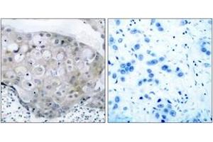 Immunohistochemistry analysis of paraffin-embedded human breast carcinoma, using VEGFR2 (Phospho-Tyr951) Antibody. (VEGFR2/CD309 antibody  (pTyr951))