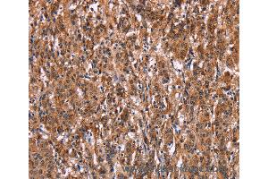 Immunohistochemistry of Human liver cancer using LILRB1 Polyclonal Antibody at dilution of 1:50 (LILRB1 antibody)