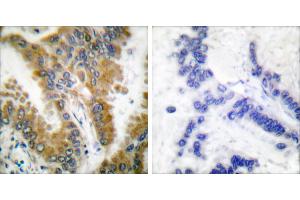 Peptide - +Immunohistochemical analysis of paraffin-embedded human lung carcinoma tissue, using CrkL (Ab-207) antibody (#B0067). (CrkL antibody  (Tyr207))
