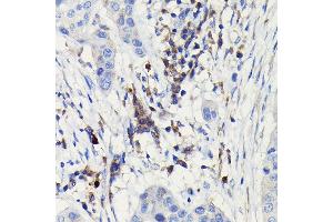 Immunohistochemistry of paraffin-embedded human esophageal cancer using iNOS Rabbit pAb  at dilution of 1:100 (40x lens).