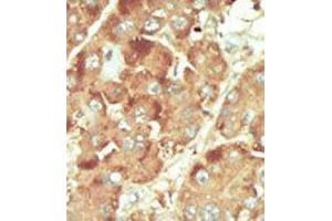 Formalin-fixed and paraffin-embedded human cancer tissue reacted with the primary antibody, which was peroxidase-conjugated to the secondary antibody, followed by DAB staining. (Nemo-Like Kinase antibody  (C-Term))