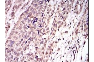 Immunohistochemical analysis of paraffin-embedded human bladder cancer tissues using TBLR1 mouse mAb with DAB staining.