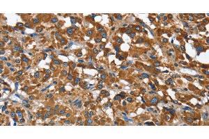 Immunohistochemistry of paraffin-embedded Human thyroid cancer using BGN Polyclonal Antibody at dilution of 1:50 (Biglycan antibody)