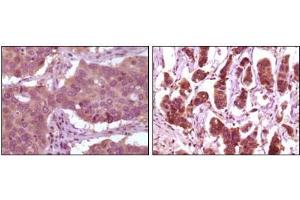 Immunohistochemical analysis of paraffin-embedded human lung carcinoma (left) and breast carcinoma (right) showing cytoplasmic localization using ERK2 antibody with DAB staining. (ERK2 antibody)