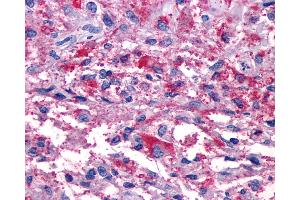 Anti-P2RY11 / P2Y11 antibody IHC of human Brain, Glioblastoma. (P2RY11 antibody  (Cytoplasmic Domain))