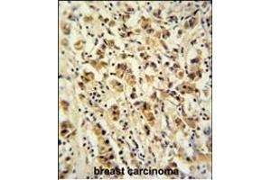 DDX49 Antibody (C-term) (ABIN653921 and ABIN2843155) immunohistochemistry analysis in formalin fixed and paraffin embedded human breast carcinoma followed by peroxidase conjugation of the secondary antibody and DAB staining.