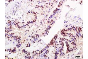 Formalin-fixed and paraffin embedded human colon carcinoma labeled with Anti-TRF2 Polyclonal Antibody, Unconjugated (ABIN736418) at 1:200 followed by conjugation to the secondary antibody and DAB staining (TBPL1 antibody  (AA 301-400))