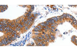 Immunohistochemistry of paraffin-embedded Human colon cancer tissue using KCNC2 Polyclonal Antibody at dilution 1:100 (KCNC2 antibody)