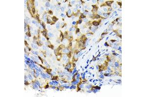 Immunohistochemistry of paraffin-embedded human breast cancer using Thymidine Kinase 1 Rabbit pAb (ABIN6132726, ABIN6149198, ABIN6149199 and ABIN6221245) at dilution of 1:100 (40x lens). (TK1 antibody  (AA 1-234))
