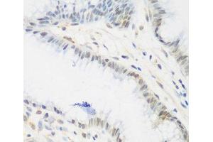 Immunohistochemistry of paraffin-embedded Human stomach using IGF2BP3 Polyclonal Antibody at dilution of 1:200 (40x lens). (IGF2BP3 antibody)