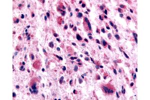 Anti-GABABR1 / GABBR1 antibody IHC of human Brain, Glioblastoma. (GABBR1 antibody  (N-Term))