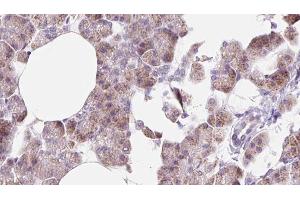 ABIN6273225 at 1/100 staining Human pancreas cancer tissue by IHC-P. (DCTN6 antibody  (Internal Region))