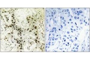 Immunohistochemistry analysis of paraffin-embedded human breast carcinoma tissue, using FOXI1 Antibody. (FOXI1 antibody  (AA 191-240))
